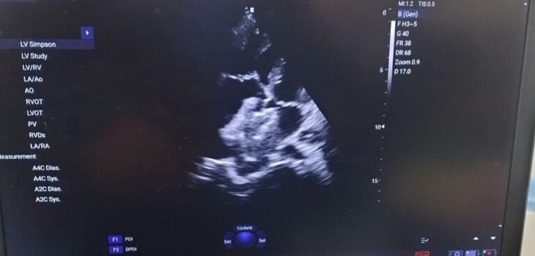 SN Medical College Agra doctors team successful heart surgery ASD device closure news 2026