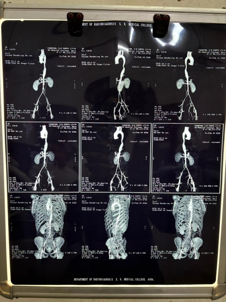 SN Medical College Agra doctors Dr Himanshu Yadav successfully perform Coarctation of Aorta stenting surgery on 17 year old boy, medical history