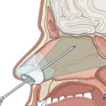 एसएन मेडिकल कॉलेज के ईएनटी विभाग ने रचा इतिहास: मस्तिष्क से टपक रहे पानी का दूरबीन विधि से किया सफल ऑपरेशन, महिला को मिली नई जिंदगी एसएन मेडिकल कॉलेज आगरा में ईएनटी विभाग द्वारा सीएसएफ राइनोरिया की जटिल दूरबीन सर्जरी - ताज न्यूज़।